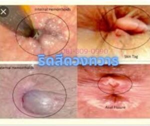 ริดสีดวงทวาร